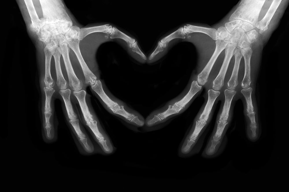 Vitamin K2 - Directing Calcium To Where It Belongs